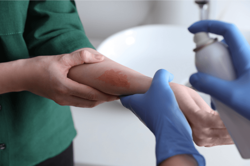 burn injury victim getting treated