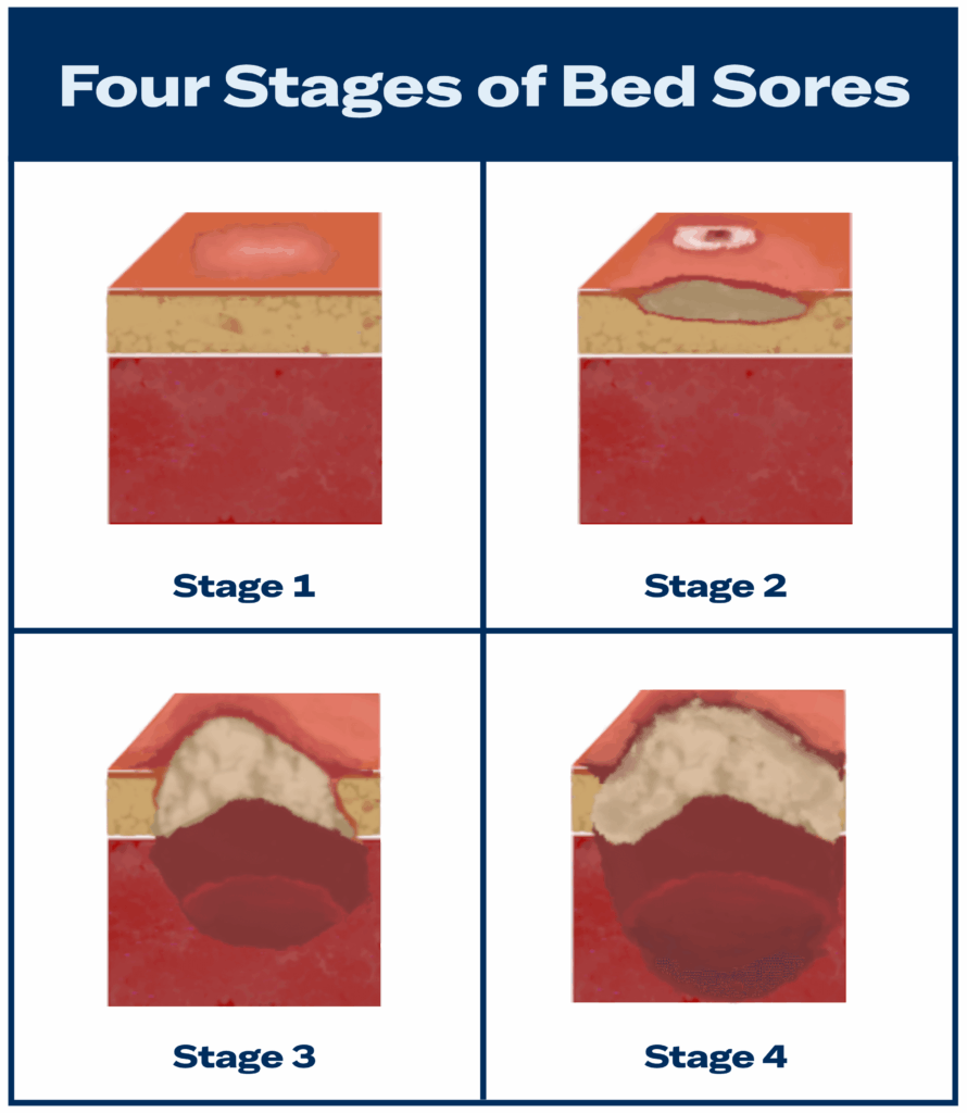 stages of bedsores
