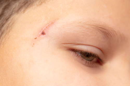 Close-up of a child’s healing facial wound from a dog bite, showing the lasting impact of Child Dog Bite Injuries.